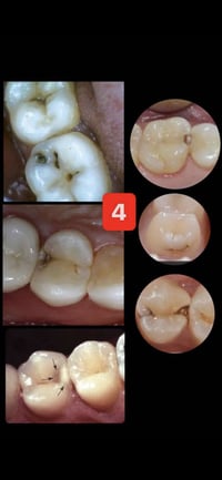 قلع أسنان • علاج تسوس • جامعة الموصل