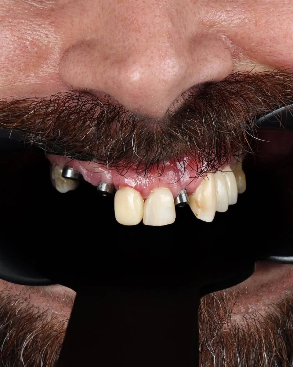 زرع الأسنان مو بس تعويض لسن مفقود🦷✨
هو استعادة للثقة والابتسامة والراحة بالحياة اليومية. إذا كنت تعاني من فقدان سن أو أكثر، زراعة الأسنان تمنحك حلاً ثابتاً وطبيعياً بمظهر ووظيفة تشبه الأسنان الأصلية. ابتسامتك تستحق الأفضل، وإحنا موجودين حتى نرجعها بأجمل صورة😍✨

متواجدين طيلة ايام   الاسبوع 
نستقبلكم بكل حُب♥️
العنوان : الديوانية/ تحت الجسر المعلق / بناية فندق الديوانية سابقًا / مقابل المحافظة

للحجز والاستفسار 
***********
***********
