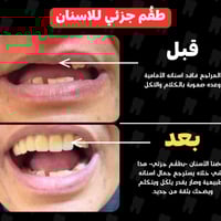 طقم متحرك • تعويض أسنان • جامعة كربلاء