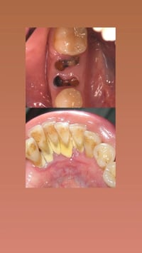 قلع جذور • تنظيف اسنان • عيادات جامعة العميد