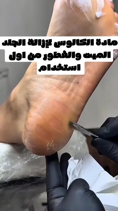 مو كل مشكلة بالقدمين تحتاج صالون أو جلسات مكلفة 👣✨
الجلد الميت والخشونة والتشققات صارت من الماضي عند كثير من الزبونات بعد استخدام هذا المنتج 🤍

الفرق واضح والنتيجة تتكلم بنفسها 😍

🚚 متوفر توصيل لجميع محافظات العراق

للاستفسار أو الحجز راسلينا خاص 📩


**إذا كنت صاحب هذا الإعلان وتريد حذفه لأي سبب، رجاءا أرسل رسالة إلى الدعم الفني**