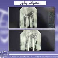 علاج تجويف جراحي وعمل حشوات جذور للاسنان  الفحص مجاناً   يسعدنا استقبا...