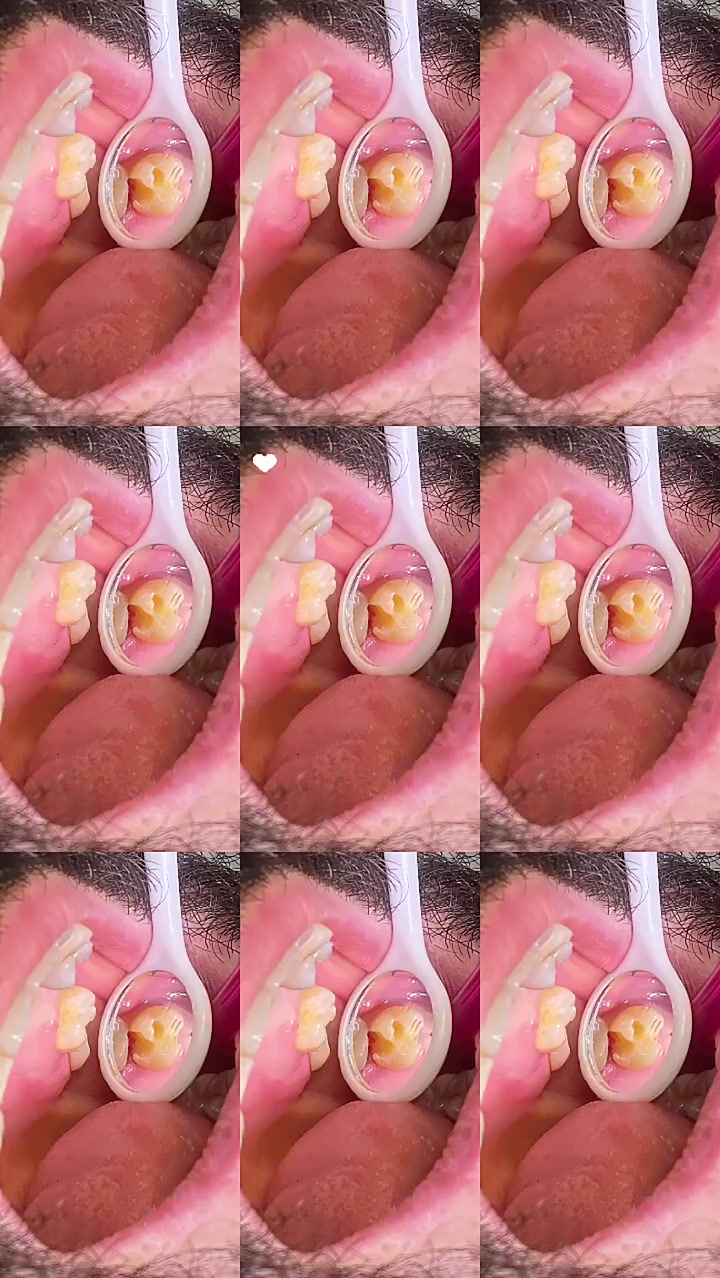 عيادة جوهرة الحياة لطب الأسنان ✨
حيث تلتقي الخبرة بالجمال… وتبدأ ابتسامتك بثقة
نقدّم لكم باقة متكاملة من خدمات طب وتجميل وجراحة الأسنان بأحدث التقنيات العالمية، وتشمل:

🦷 تقويم الأسنان بجميع أنواعه.

🦷 زراعة الأسنان المتطورة بأعلى معايير الدقة والثبات.

🦷 تصميم وتجميل ابتسامة الأسنان.

🦷 حشوات الأسنان الحديثة. التجميلية والعلاجية.

🦷 قلع الأسنان العادي والجراحي.

✔️ ضمان جودة العمل والمواد المستخدمة.

✔️ مركز تخصصي متكامل.

✔️ كادر طبي من أطباء
 واختصاصيين ذوي خبرة عالية.

جوهرة الحياة… لأن ابتسامتك تستحق الأفضل 💎

📌 الدورة _ المهدية الثانية _ مقابل جامع شاهين الكبيسي. 

📞 *********** 

 #صحة #طب #أسنان #صحة_الاسنان #مجمع_الحياة_الطبي_لصحة_افضل
