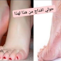 كالوس قدم اصلي • ازالة الجلد الميت • البصرة