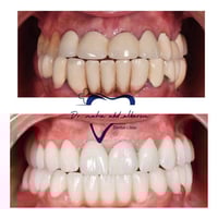 هوليود سمايل زيركون • فك علوي وسفلي • الرمادي شارع المستودع