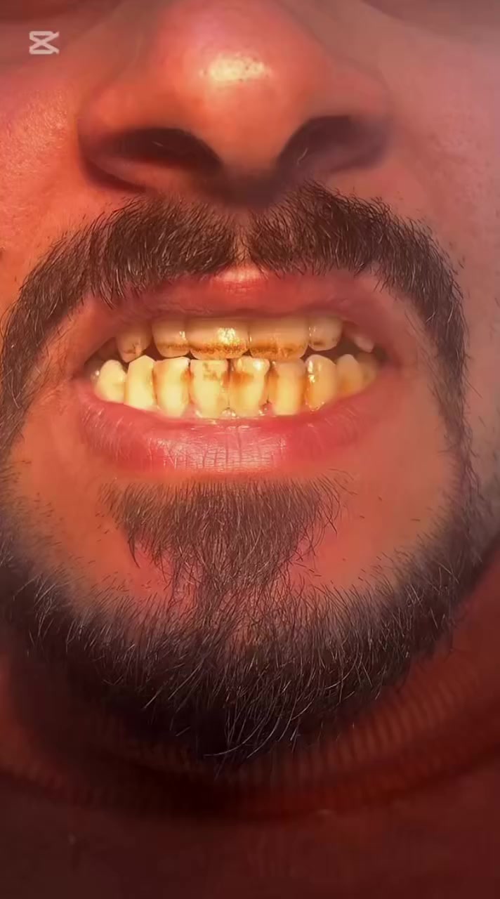 تنظيف أسنان وتلميع ب١٥ الف بس بدل ٢٥ الف

✨ الفرق يبان من أول نظرة!
والصوره تحجيلك عن الشغل وجماله 

إذا أسنانك بيها تصبغات أو جير وتريد ابتسامة أنظف وأجمل، الحل بسيط وسريع 👌

🦷 تنظيف الأسنان وإزالة الجير مع التلميع
يعطيك:
 • أسنان أنظف ولمعة واضحة
 • إزالة التصبغات والتكلسات
 • إحساس بالانتعاش والنظافة

🔥 النتيجة: فرق واضح ومبهر من أول جلسة

📍 في عيادة البيت الطبي
العنوان: بغداد – المحمودية – حي الموظفين – مقابل التانكي 

📅 الحجز *********** من ٣ لل٧
احجز وخلّي ابتسامتك تحچي عنك
