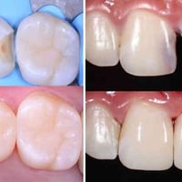 علاج اسنان مجاني • حشوة ضوئية • عيادات جامعة الحلة