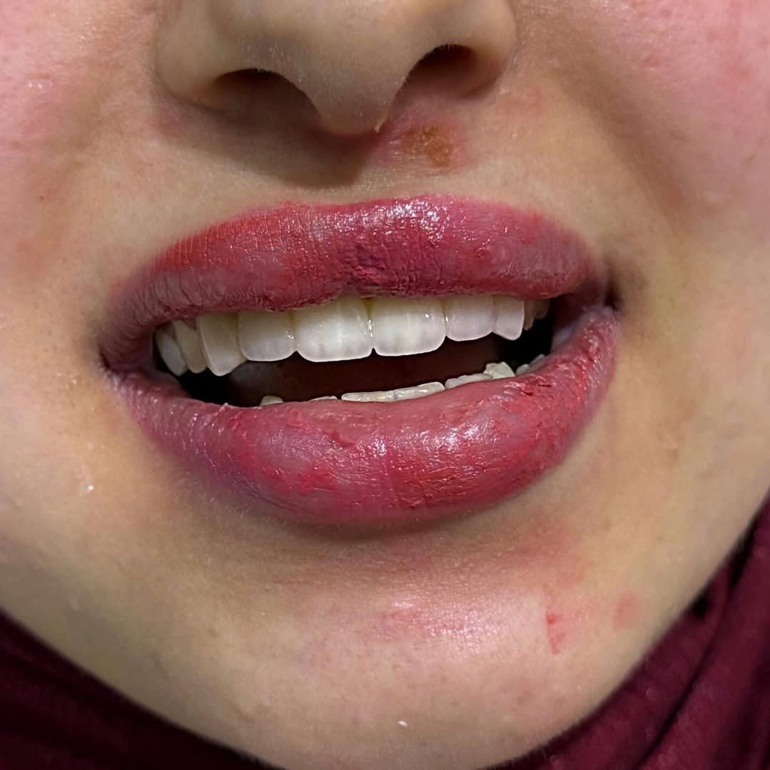 ✨ ابتسامة جديدة… ثقة أكبر ✨

من أول جلسة تگدر تشوف الفرق 👌

تركيب تجميلي يغيّر شكل الابتسامة ويعطي مظهر طبيعي وناصع 🤍

📸 الصورة تحچي عن نفسها – قبل وبعد

📍 عيادة لؤلؤة بدرة

📞 للحجز والاستفسار: ***********

ابتسامتك مسؤوليتنا 🌸

لا تتردد… خلّي ابتسامتك تحچي عنك �
