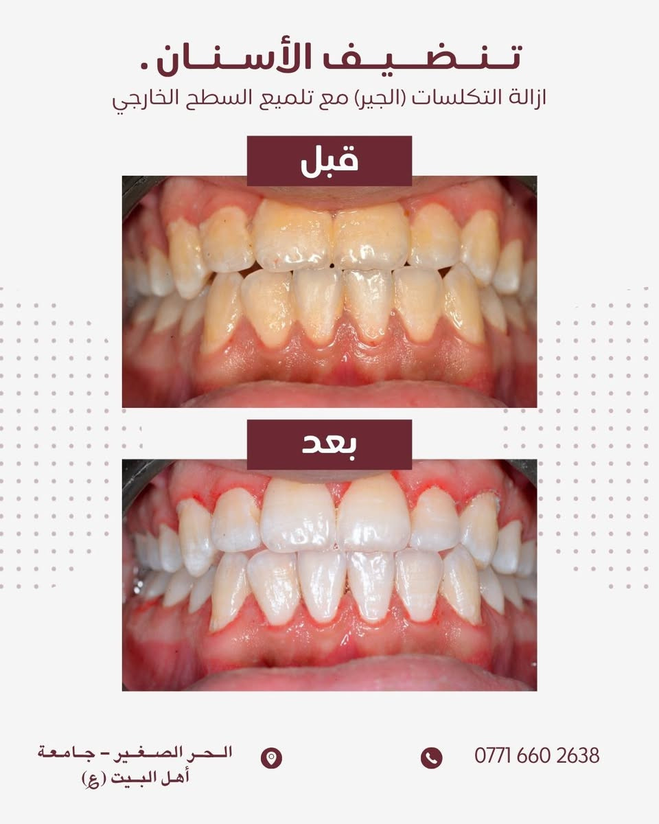 مـجـانـاً 
عمل خيري موافقة الادمن المحترم 
السلام عليكم 

الأسنان بصورة عامة حالها حال اي عضو بجسمك ضروري تعتني بيهم و ترتبهم، الاهمال ب مرور الوقت يكلفك جهد و قيمة مادية 💲 .
واني ب صفتي طالب متدرب ممكن اساعدك نخلص من كل مشاكلك تحت أشراف افضل الكوادر الطبية .
● جميع الحالات المذكورة ادناة مجاناً و جودة عالية ✔️.
● اضافةً علاج جميع حالات الاطفال من ( 6 - 15 ) سنة .
و مشاكل المفصل الفكي او التهابات السان و الثه 

تفاصيل اكثر : اتصال او واتساب 

0771 660 2638 🦷 كربلاء, العراق
