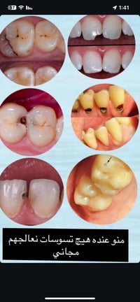 العلاج مجانا اي شخص يعاني من تسوس بالاسنان الامامية او الخلفية ويحتاج ...
