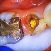 ترميم وبناء سن بحشوة زاركون يابانية تجميلية مع وتد طبيب الاسنان الاختص...