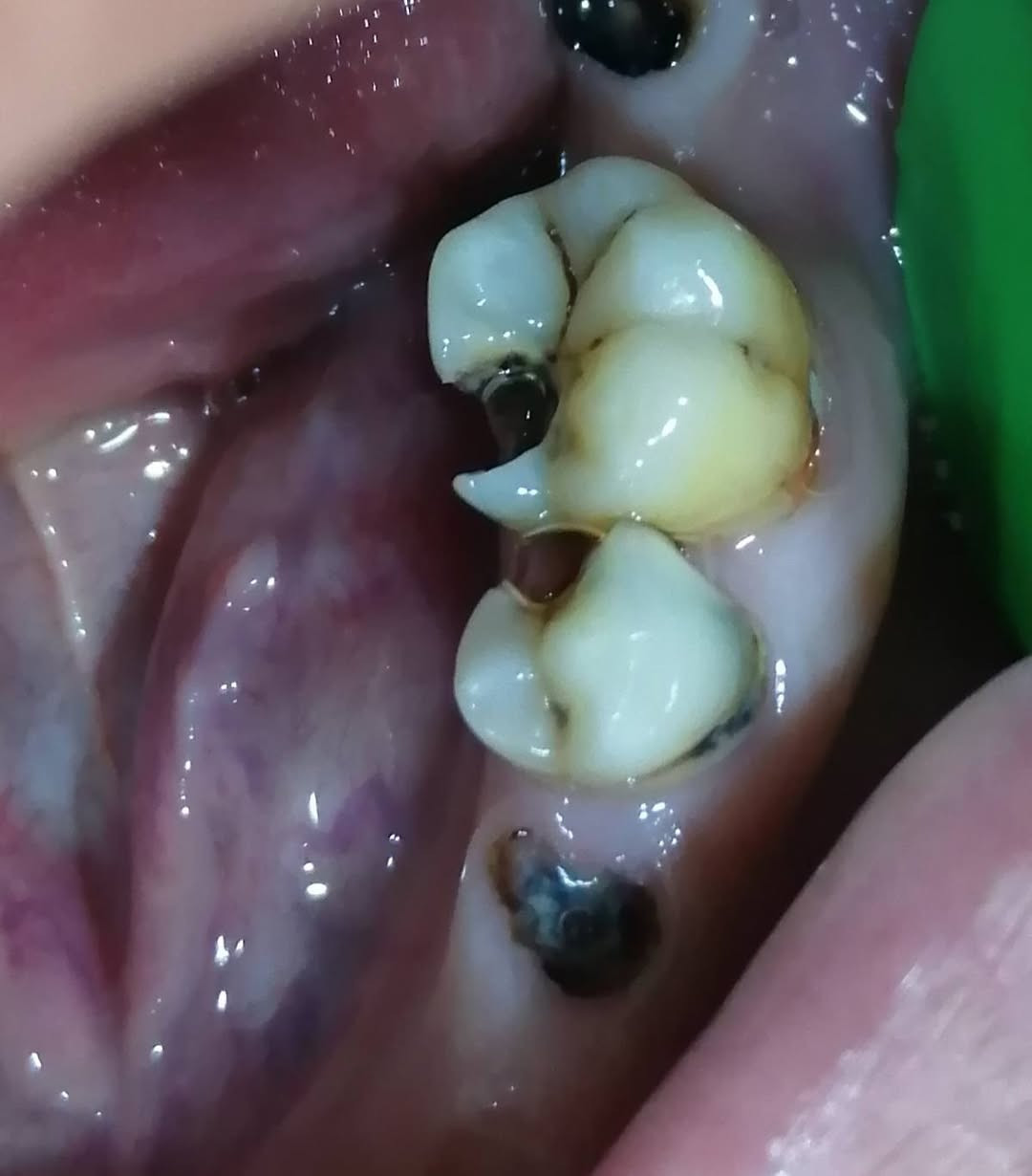 ترميم السن الضاحك السفلي بحشوه جذر مع حشوه تجميليه.. د مهند عبد الجواد الطحان.. ماجستير ودبلوم عالي تعويض الأسنان.. سايدين مستشفى القياره.. مقابل باب الطوارى.. مجاور صيدليه عبدالله المعماري.. طابق ارضى.. للحجز والاستفسار التواصل على الرقم ***********#
