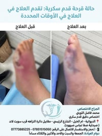 قرحة قدم سكرية • غرغرينا • الديوانية