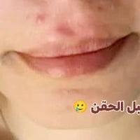 قبل وبعد • حقن • رسمة كرزية روسية