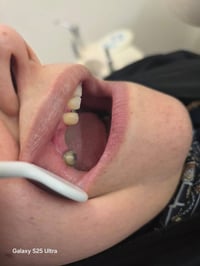 ٤ أسنان زاركون • عيادة الرواسي الدولعي • د. سيف رعد