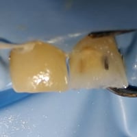 ترميم سن أمامي • مهند الطحان الهاشمي • مجاور صيدلية عبدالله