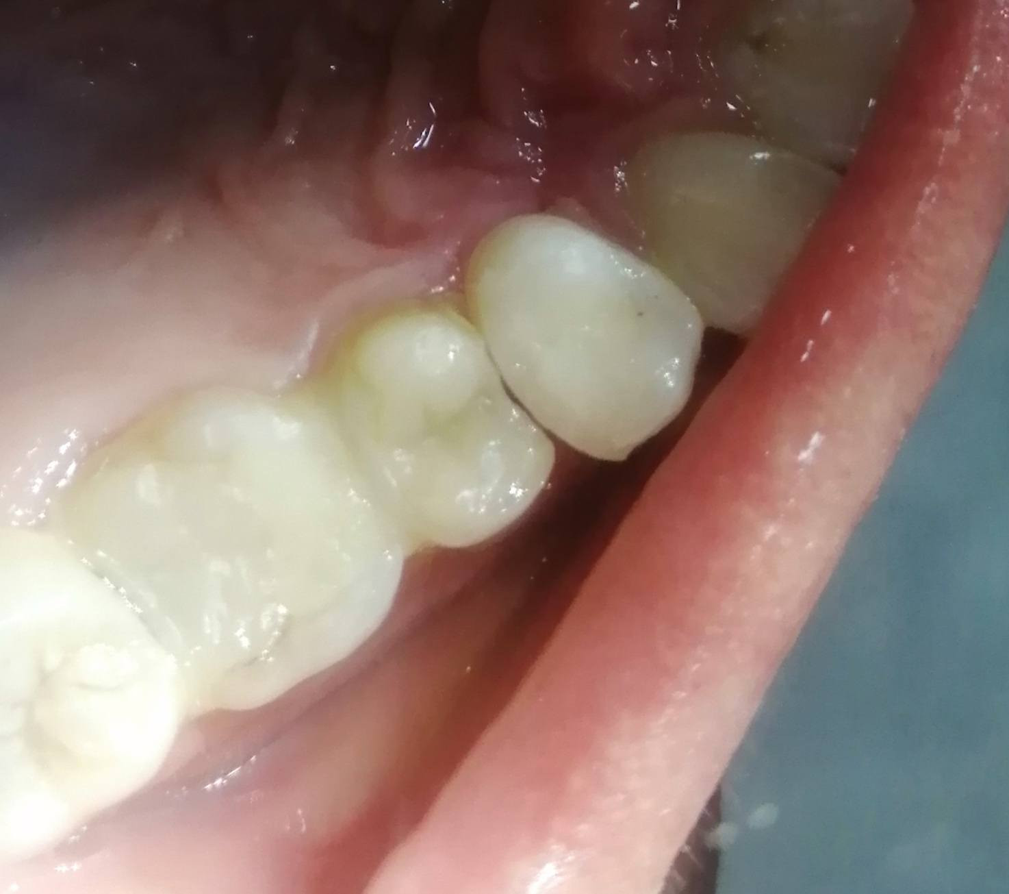 حشوه تجميليه للسن الضاحك العلوي باستخدام العازل المطاطي..
د مهند عبد الجواد الطحان الهاشمي
ماجستير ودبلوم عالي تعويض الأسنان
سايدين مستشفى#القيارهالعام
مقابل باب الطوارى الرئيسي
مجاور صيدليه عبدالله المعماري للحجز والاستفسار التواصل على الرقم ***********# طابق ارضى.
