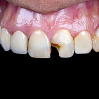 حشوات ضوئية • قلع أسنان • كلية طب الأسنان