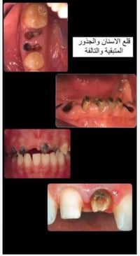 منو محتاج قلع لاسنانه او عنده حاله ضمن الحالات التاليه 👇 للحجز والاستف...