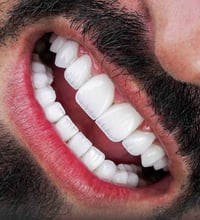 ابتسامة زركون • ابتسامة إيماكس • حي الفارس