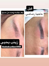 مسح تاتو • نتيجة أول جلسة • ناصريه