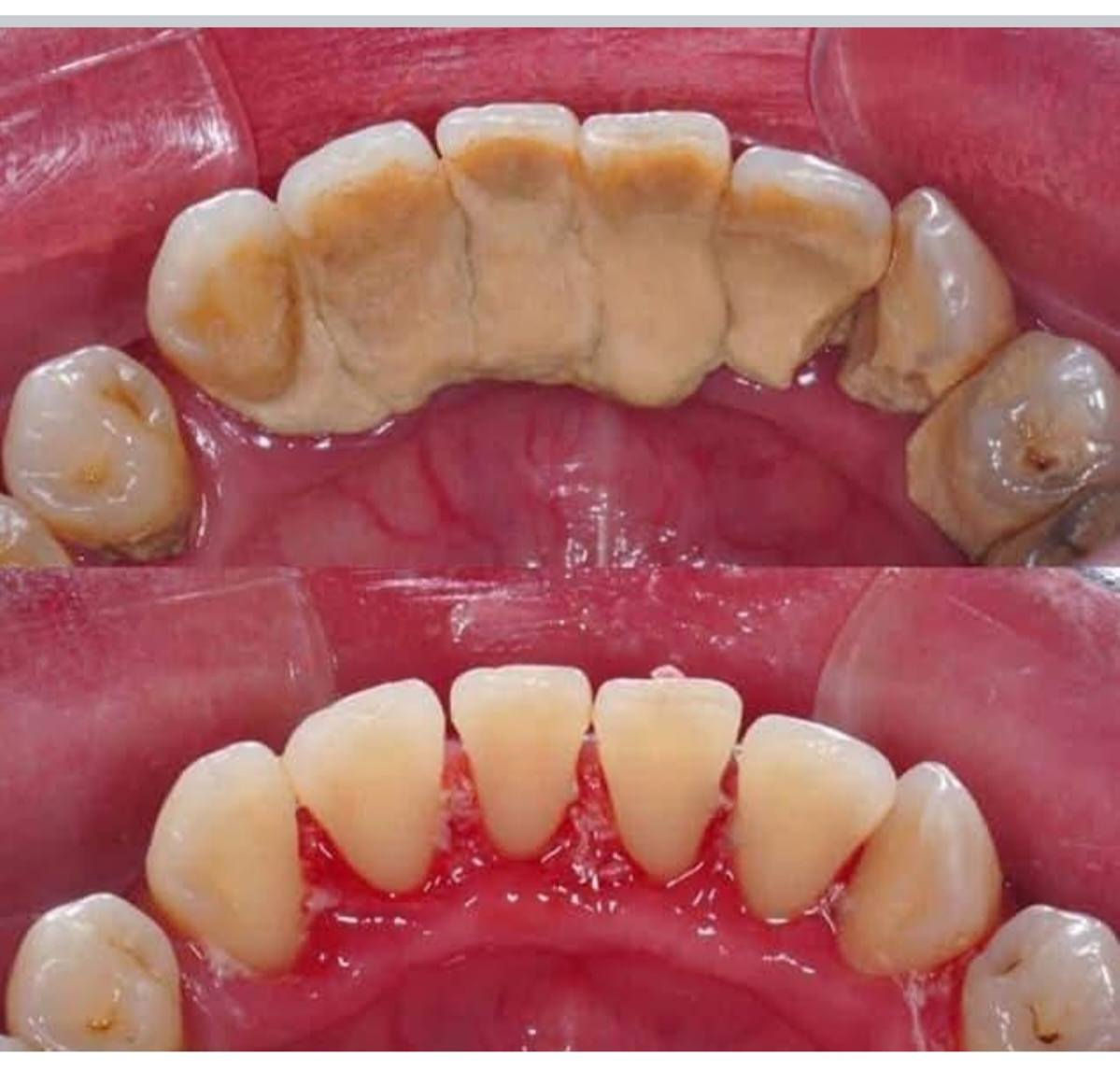 تعلن جامعة الكفيل عن تقديم خدماتها في مجال طب الاسنان
🔴مجانا 🔴مجانا 🔴مجانا
🔴قلع الاسنان التالفة والجذور المتبقية
🔴طقم اسنان جزئي متحرك
🔴حشوات ضوئية
🔴تنظيف الاسنان
التواصل على الواتساب***********
العلاج مجانا تحت إشراف أطباء اختصاص
📍عيادات جامعة الكفيل /شارع الإسكان/ قرب مستشفى الزهراء
