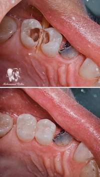 ✌🏻مميزون 😇💪🏻  ✨ حشوات ضوئيه دائميه 🦷 واعاده تفاصيل            السن  با...
