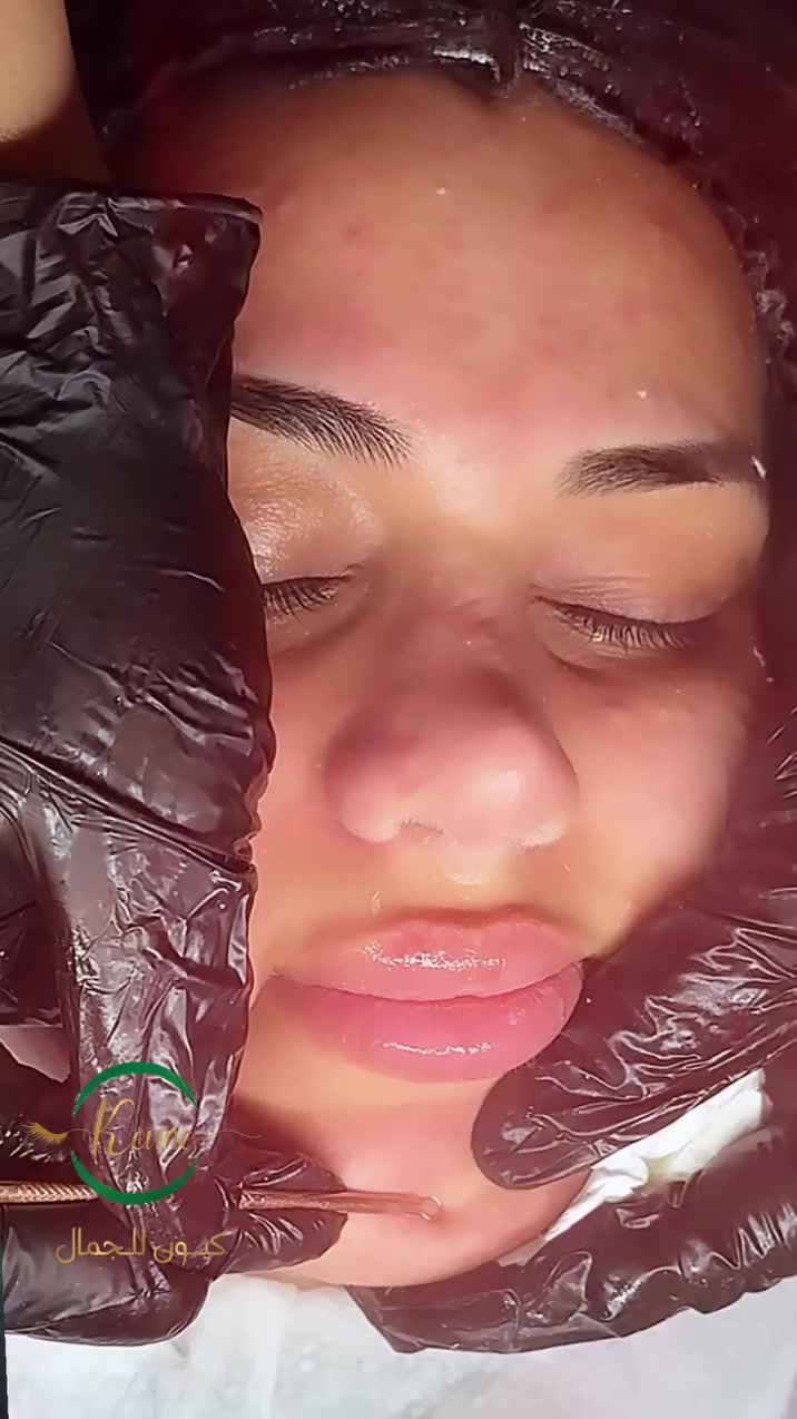 ✨ تنظيف بشرة ملكي بالأوكسجين + إزالة الرؤوس السوداء + تبييض مع كيون للجمال ✨

لأن بشرتج تستحق العناية والاهتمام، من الضروري شهرياً تعيدين حيوية ونضارة بشرتج وتحافظين على إشراقتها. 🌸

مع كيون للجمال نوفر لج:
💎 تنظيف بشرة ملكي بالأوكسجين
💎 إزالة الرؤوس السوداء وتنظيف عميق
💎 تبييض وتوحيد لون البشرة
💎 ترطيب وإنعاش للبشرة

كوني أكثر تألقاً وجمالاً مع كيون للجمال، لأن العناية ببشرتج سر جمالج الدائم. ✨

📍 ديالى - بعقوبة الجديدة - شارع مستشفى بعقوبة العام
📞 ***********

🕚 الدوام يومياً من الساعة 11 صباحاً إلى 8 مساءً
نظام العمل: أسبقية الحضور داخل المركز. 🌷#كيون_للجمال_2021_حسن
