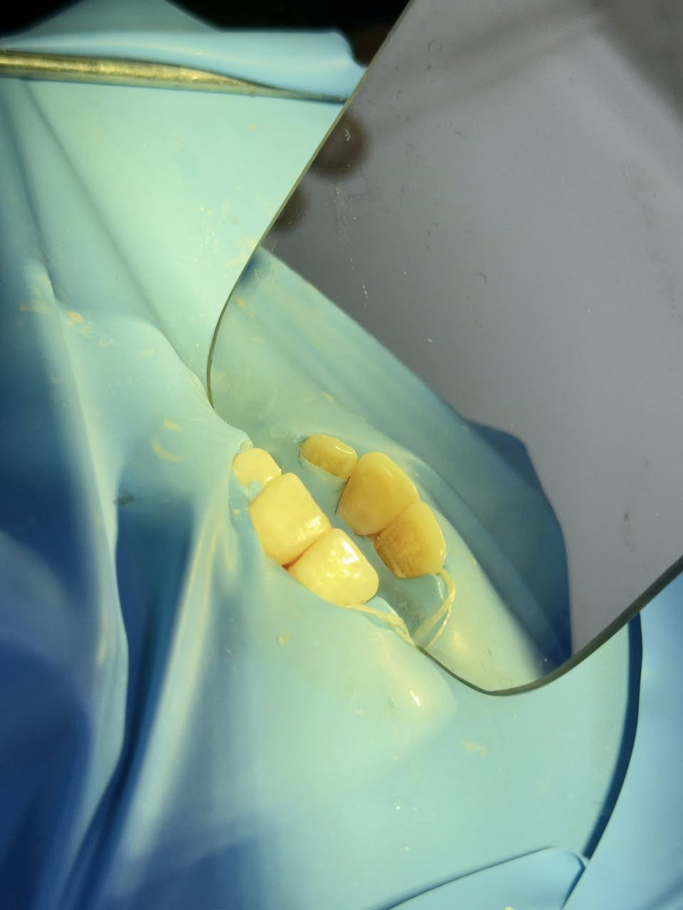 مستحيل خطأ واحد بالفرشاة يخلي أسنانك أضعف مع الوقت!”

حالة اليوم مراجع بسبب التفريش الخطأ ادى الى تسوس وكسر بالسن وتمت اعادة بناء السن بحشوات ضوئيه دائميه 

عروضنا مستمرة ع جميع حالات الاسنان والتجميل الخاص بالبشرة 

للتواصل : ***********
