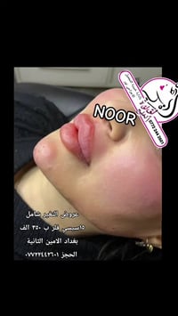 فلر كوري • فلر شفاه • بغداد الامين الثانية