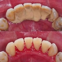 تنظيف أسنان مجاني • إزالة التكلس • عيادات جامعة كربلاء