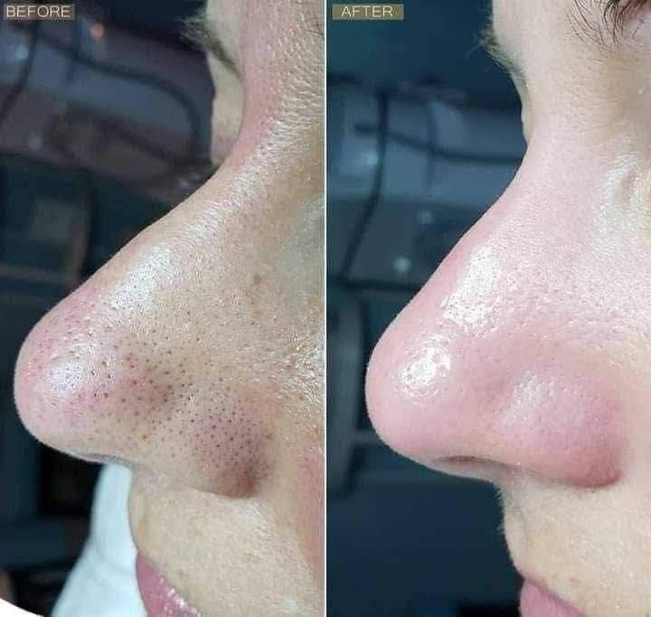 للحجز *********** أو خاص 
جهاز التقشير العميق للبشره جهاز التراسونيك سكن سكرابر Ultrasonic Skin Scrubber لتقشير البشرة العميق بالموجات فوق الصوتية ...
---------جهاز تقشير البشرة 
يعمل على ازالة الجلد الميت وعلاج التجاعيد والدهون والحبوب والحفر والبثور والترهلات وحب الشباب واثار حب الشباب كذلك تفتيح - تبييض - تحفيز افراز الكولاجين - تقشير سطحي بالالتراسونيك - تفتيت دهون البشرة يشد البشرة ويعيد لها نضارتها بالالتراسونيك - وعلاج الهالات السوداء - تجديد خلايا البشرة وشد البشرة
جهاز تنظيف وتقشير البشره #التراسونك 
شي عجيب شغله هذا الجهاز يزيل الرؤوس السوده ويقشر البشره بكل سهوله

Ultrasonc shovel
لتنظيف البشره العميق بتقنيه الموجات فوق الصوتيه
يعمل على تقشير وتنظيف الوجه بالموجات الفوق صوتيه (موجات التراسونيك عاليه التردد اي بذبذبات تلك الموجات يتم التنظيف العميق لها
يقوم بتنظيف عميق لبشره وجهك وازاله الزيوت منها (جيد للبشره الدهنيه ) وبالتالي ازاله الجلد الميت
وتحفيز لخلايا البشره وتخليصها من السموم والشوائب الضاره والعالقه بها
وكذالك تحفيز الكولاجين المسؤؤل عن نضاره البشره وشد البشرة

وقبل الاستخدام نقوم بتنضيف بشرتك من اي مكياج عالق به وابدئي بالتتقشير

السعر 13 الف عرض خاص
