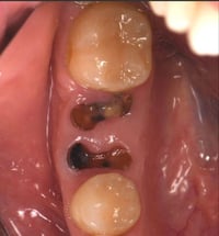 مساء الخير متاح قلع جذور أسنان متبقية او أسنان متهالكة مجانا بدون تكلف...
