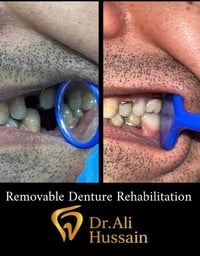 إجراء قلع للجذور التالفة والأسنان المتحركة لغرض تحضير الفم لتركيب الأط...