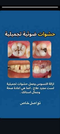 حشوة اسنان • قلع اسنان • مجاناً