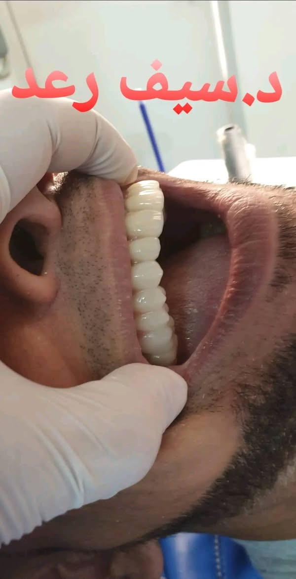 ✨ تريد ابتسامة هوليود ثابتة وبخصم 30%؟

هسه فرصتك حتى تحصل على ابتسامة ناعمة، مرتّبة، وتغليف زاركون ألماني مع تكنيك 7D اللي يطي شفافية وتفاصيل طبيعية تخبّل 😍

✔️ تغليفات ألمانية ثابتة
✔️ ضمان التركيبات 

💬✨مع عياده الرواسي لطب وتجميل الاسنان 
ابْتِسَاَمَتِگِ يمنااا غيررر

🧑‍🔬الدكتور سيف رعد /خبره اكثر م̷ـــِْن عشر سنوات في مجال طب وتجميل الاسنان 

📍 الحريه – الدولعي – داخل سوق الدولعي – ثاني فرع ع اليمين 
📞 ***********
