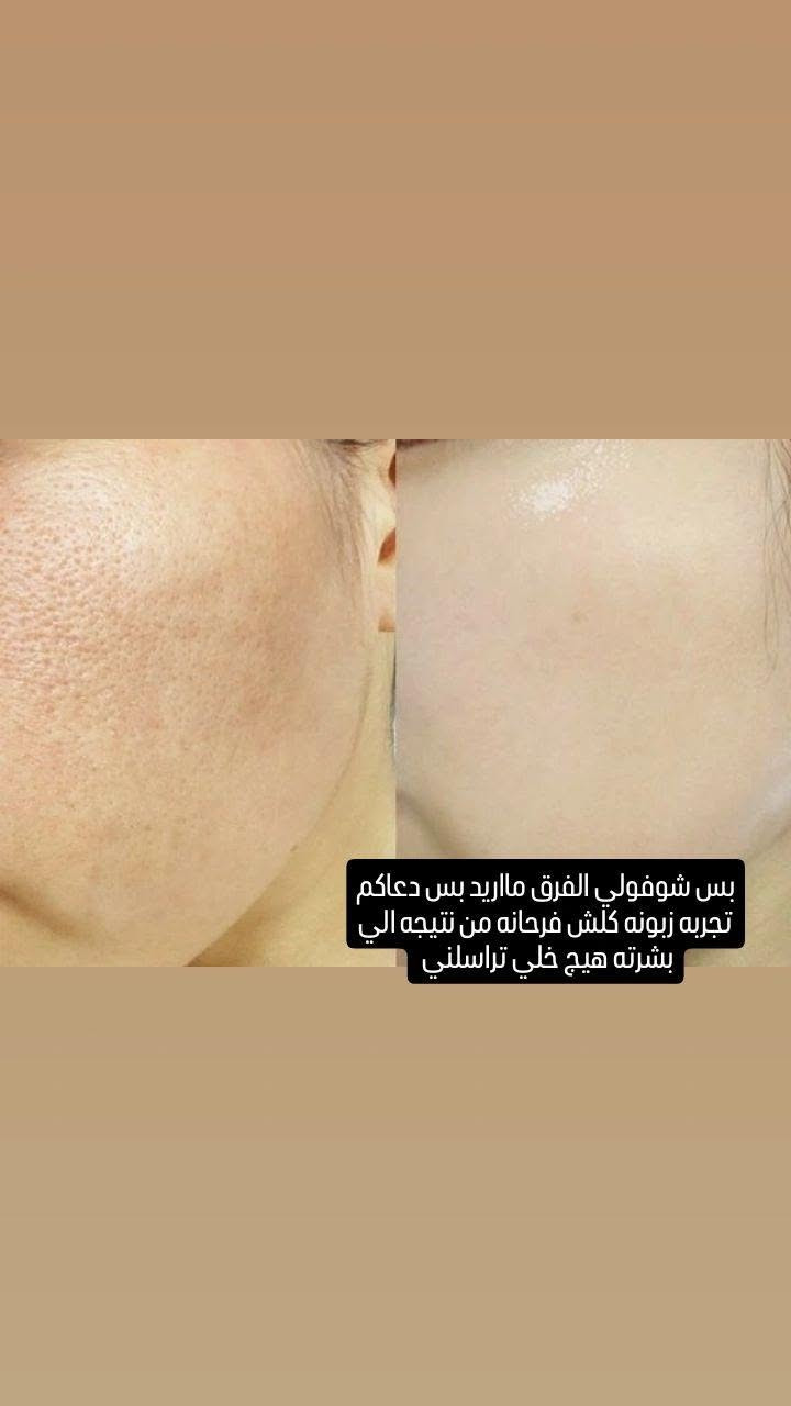 كريم المسامات وتوحيد لون البشره 
تقليل البقع الداكنه والتصبغات 
تنضيم افراز الدهون وتنقيه المسام 
سارعوا قبل نفاذ الكميه 

# 

 #ا عالم الصبايا #اكسبلور_العراق_السعوديه_الاردن_ايران_الكويت_طق_لايكات_كومنت_يلاا #اكسبلور_explore #ترند #ترندیول بغداد, العراق


**إذا كنت صاحب هذا الإعلان وتريد حذفه لأي سبب، رجاءا أرسل رسالة إلى الدعم الفني**