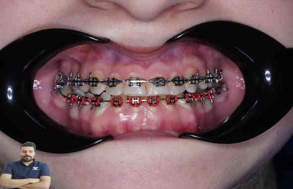 عذراء كانت تعاني من تقدم بالفك السفلي كدرنة نعدل اسنانهة ونرجع ابتسامتهة خلال مدة سنة ونص من العلاج

العنوان / المسيب / شارع البلدية / مقابل دكتور جعفر وفي للاطفال 

للحجز والاستفسار 
***********
***********
