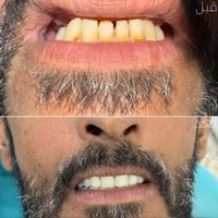 ابتسامة هوليود • تجميل أسنان • تيجان الزيركون • قشور خزفية • علاج تصبغ...