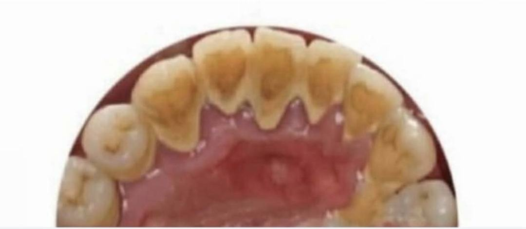 مجاناااا
الي عنده تكلسات باسنانه مثل الي بالصورة ويريد تنظيف لاسنانه يتواصل وياي ع خاص او يتصل على الرقم ***********
شارع 40 مجاور صيدلية سلامتك 
(العلاج مجاني)
