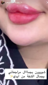 فلر شفة • تعديل حقن • الكوت الهورة