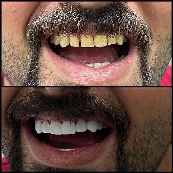 تعلن عيادة إبرو لطب الأسنان وتجميل عن عروض وتخفيضات في قسم الأسنان وتجميل مكان العياده ماجديه نهاية شارع الجامع مقابيل مأكولات البيك ويوجد ايضا ليزر لإزالة الشعر والوشم رقم الحجز ***********
