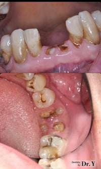 اخوان اي شخص محتاج قلع اسنان او جذور متبقية  و يريد يقلعها القلع مجاني...