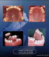 علاج مجاني • علاج أسنان • جسر الجادرية