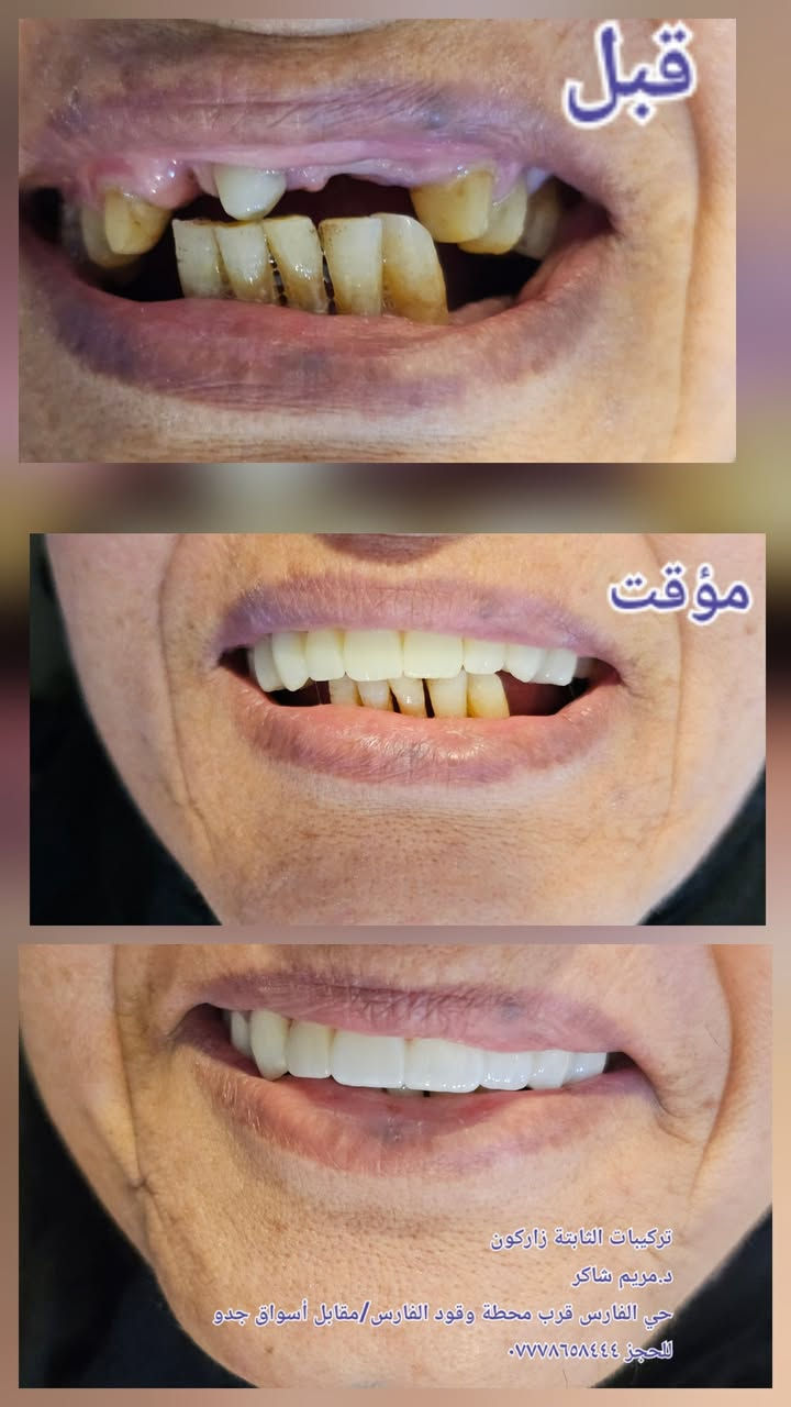 عمل حشوات الجذور للاسنان وبناء الاسنان وتغليفها بتركيبات الزاركون الثابتة وتعويض الاسنان المفقودة 
حي الفارس الشارع الرئيسي قرب محطة وقود الفارس 
د.مريم شاكر 
للحجز واتس ***********
يتوفر خصم ٤٠ بالمية 
يتوفر خصومات للعوائل ذات الدخل المحدود #قلع #حشوات#حشوات جذور #تركيبات ثابتة ومتحركة #زراعة اسنان #تقويم اسنان
