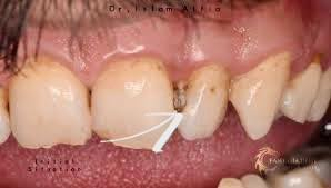 شباب اي شخص عندة مثل هاي الحالات نكدر نشتغله حشوات تجميليه وبافضل المواد
وبشكل مجاني ( العلاج مجاني )

الموقع✨

كربلاء/ طريق الحر الصغير 

جامعة اهل البيت 

لتواصل واتساب …📞

***********
