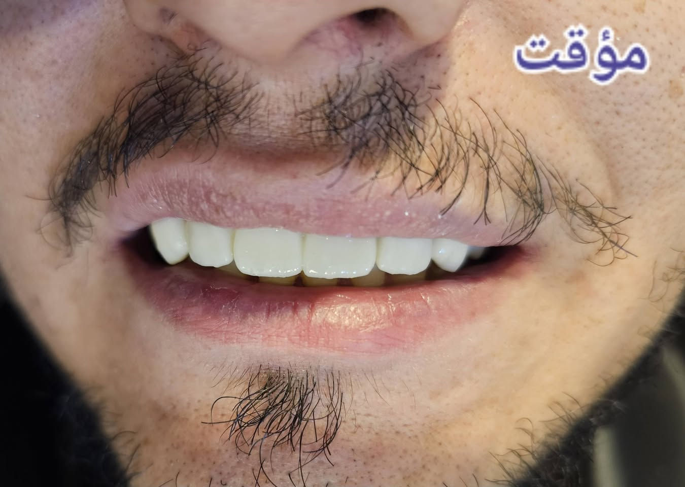 هدوء، واهتمام، وعناية تبدأ من المكان 🤍

Where precision comes first 🦷
Where space is designed to feel open and calm 🤍
Where comfort begins before you sit down ✨
⚘️مراجع يعاني من اصفرار وفراغات بين الاسنان ..تم تنظيف الاسنان وصقلها وعمل تركيبات مؤقتة ..وعمل تركيبات الايماكس الثابتة  ذات القوة والجمالية ليكسب بذلك ابتسامة مشرقة⚘️
📞للحجز واتس  ***********
يوجد خصم ٣٥%للعوائل ذات الدخل المحدود 

 📍 كربلاء _حي الفارس _الشارع الرئيسي قرب محطة وقود الفارس/مقابل اسواق جدو
