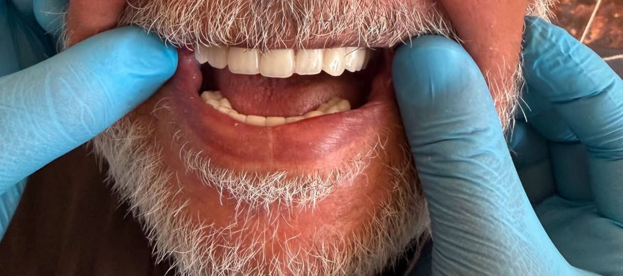 ابتسامتك المثالية صارت أقرب إلك ✨
خصومات خاصة على ابتسامات الأسنان لفترة محدودة 😁🦷
▪️ الزيركون
▪️ الإيماكس
▪️ والسيراميك 
المختبر الابداع السوري  لصناعة الاسنان
و التعويضات السنية وتركيب الأسنان
وبأنسب الاسعار بجميع المحافظات
العراقية 
ملاحظة لدينا كادر يزور المريض للبيت ويتم العمل في المنزل 
للتواصل والحجز. ***********»꧁꧂«***********
