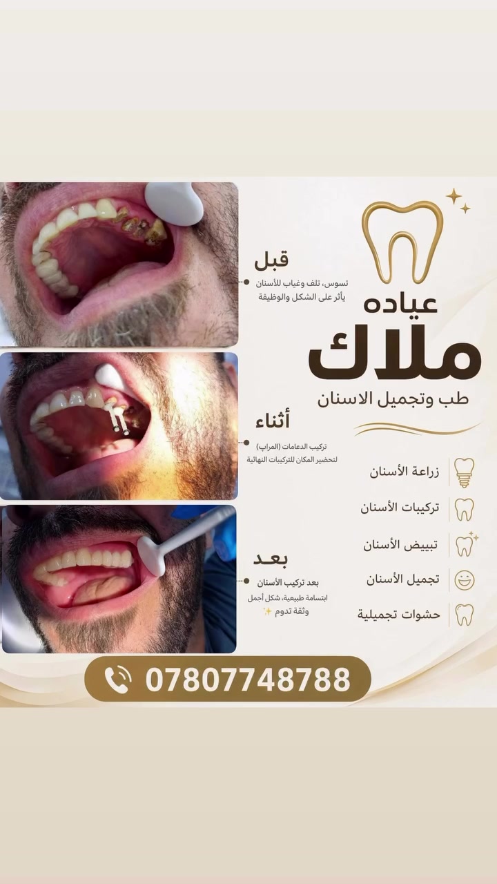 � من حالة فقدان وتلف الأسنان إلى ابتسامة متكاملة وطبيعية.

في هذا العمل تم:
✅ تقييم الحالة ووضع الخطة العلاجية المناسبة
✅ زراعة الدعامات (المرابط) بدقة عالية
✅ تركيب الأسنان النهائية بأفضل الخامات
✅ استعادة الشكل الجمالي والوظيفة الطبيعية للأسنان

🌟 النتيجة:
ابتسامة طبيعية، مظهر أجمل، وثقة أكبر بالنفس.

نحرص في عيادة ملاك على تقديم أحدث التقنيات وأفضل الحلول العلاجية والتجميلية للحصول على نتائج تدوم وتمنحك الراحة والرضا.

📍 عيادة ملاك لطب وتجميل الأسنان
📞 ***********

#زراعة_الأسنان #تركيبات_الأسنان #تجميل_الأسنان #ابتسامة_هوليود #عيادة_ملاك طب_الأسنان ابتسامة_جميلة العر

