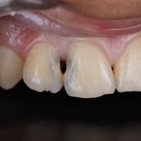 التسوس المخفي بين الاسنان😖 من التسوسات المزعجة للمراجعين وخاصتاً اذا ك...